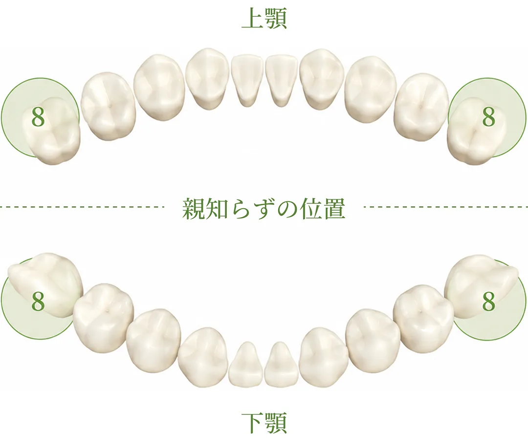親知らずの位置を示した上下の歯列図